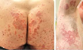 Image result for Pemphigoid