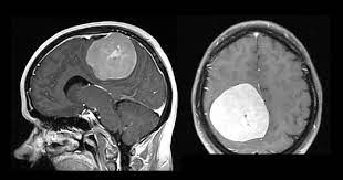 Antara fungsi otak adalah mengawal otot, sensasi, ingatan dan fungsi badan secara amnya. Kanser Otak Punca Simptom Dan Rawatan The Diagnosa