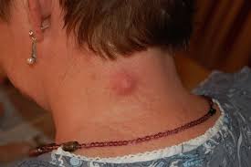 Likewise, apple cider vinegar can also be used to eradicate sebaceous hyperplasia and other skin conditions. Sebaceous Cyst Wikipedia