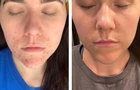 Is Beef Tallow Balm Good for Skin? Absolutely, Read our Guide.