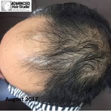 Our stem cell therapy and growth cell therapy, can switch on dormant cells and encourage them to resume the natural production of healthy how growth factors help hair regrowth. Stem Cell Hair Technology Factors Growth Cell Therapy