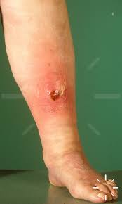 Image result for erysipel photos)