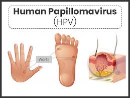 Hpv, or human papillomavirus, is a common virus that can lead to 6 types of cancers later in life. Human Papillomavirus Hpv Infection Symptoms Causes Risk Factors Treatment And Prevention Boldsky Com