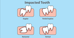 Check spelling or type a new query. Do I Need To Remove An Impacted Wisdom Tooth If It Is Not Causing Any Problems Harbour Pointe