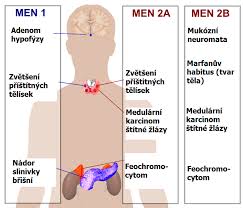 Přesto jsou příznaky u jednotlivých lidí různé. Syndrom Mnohocetne Endokrinni Neoplazie Men 2a Sippleuv Syndrom Priznaky Projevy Symptomy Priznaky A Projevy Nemoci