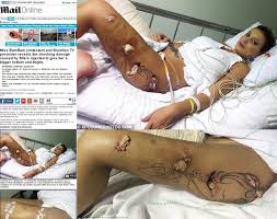 Segundo seu assessor, cacau oliver, após ter um problema com o dreno que estava usando, a modelo acabou desenvolvendo uma infecção e passou por uma nova cirurgia na noite deste domingo, 30. Imagens Chocantes De Miss Bumbum Apos Cirurgia Movenoticias