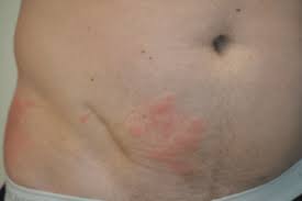 Shingles Treatment Boston Wellesley Krauss Dermatology Shingles is a viral infection that causes a painful rash. shingles treatment boston wellesley