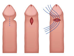 Image result for Phimosis