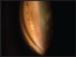 Image result for Gonioscopy