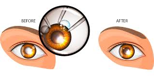 Image result for Cataract Extraction