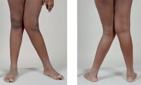 Knock knees refers to when the knees point inwards and the feet are wider apart than the knees. What Causes Knock Knees And Do They Have To Be Treated Richard Lebert Registered Massage Therapy