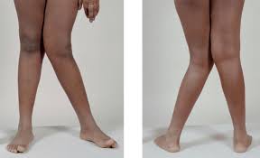 Knock knees refers to when the knees point inwards and the feet are wider apart than the knees. What Causes Knock Knees And Do They Have To Be Treated Richard Lebert Registered Massage Therapy