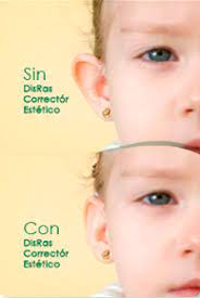 Disras Innovando A Partir De Un Remedio Casero Contra Las Orejas De Soplillo