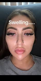 Radiesse Cheek Smile Before and After