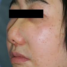 Appearance of the swelling in the left nasal wing at the initial...