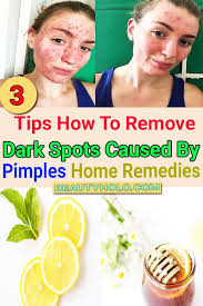 So the first step to preventing acne is keeping the skin clean and free of excess oil and dead skin cells. Pin On Women Fashion Ideas