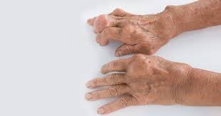 Check spelling or type a new query. Pegloticase Effective For Rapid Resolution Of Tophi In Gout