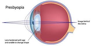 Eye Disorders And Fixes