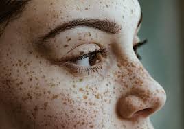 This can make them more likely to get ingrown hairs, especially. How To Prevent And Treat Pimples After A Wax