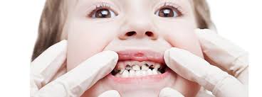 Karies Bei Kindern Was Tun Bei Kinderkaries Herold At