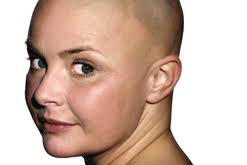 Hair Loss in Women: Gail Porter's Alopecia
