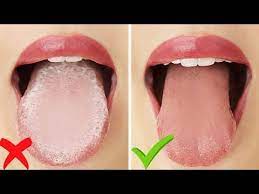 How To Get Rid Of White Tongue Bad Breath Instantly Youtube White Tongue Bad Breath Tongue