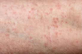 Image result for scabies bite