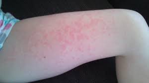 Urtikaria er en sykdom som ofte kalles elveblest. Noen Som Har Vaert Borti Elveblest Hos Barn Skravle Foreldreforum