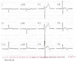 Myocarditis is an inflammation of the heart muscle (myocardium). Acute Myocarditis Mimicking St Elevation Myocardial Infarction A Case Report And Review Of The Literature