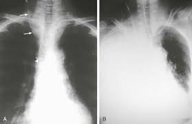 Axial nonenhanced chest ct image shows pleural calcifications (arrowheads), a loculated pleural effusion with marked pleural thickening, and extension into the chest wall (arrows). Pleural Effusion Thoracic Key