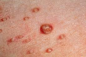 Image result for skin rash acute hiv infection