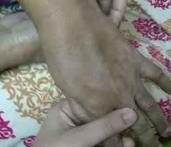 A catheter connects the port to a large vein, most often in your chest. Chemotherapy Port My Mother Is Breast Cancer India