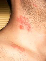 Read more about chickenpox symptoms and when to get medical advice. Kayap Definition And Synonyms Of Kayap In The Malay Dictionary