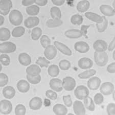 The 3 major diagnostic possibilities for microcytic anemia are iron deficiency anemia (ida), thalassemia, and anemia of chronic disease (acd). Peripheral Blood Smear In Ida Anemia Microcytosis Poikilocytosis Download Scientific Diagram