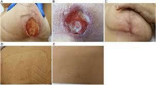 If you've received a diagnosis, here are some things you need to know about the condition. Wound After Breast Reconstruction Post Radiation Therapy A Wound At Download Scientific Diagram