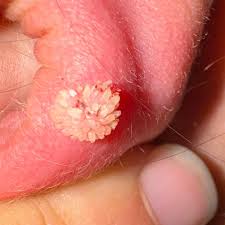 Image result for verrucae filiformes