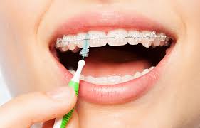 This animated step by step video explains how to brush your teeth with both conventional braces (aka: How To Clean Teeth With Braces Haug Orthodontics Alton Il