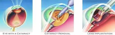 Image result for Cataract Extraction