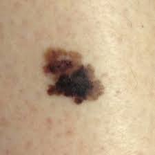 These melanoma pictures could help you spot a cancerous mole. Melanoma Pictures Example Pictures Of Melanoma Symptoms