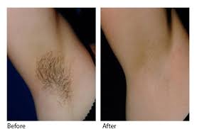 It is not recommended to do any activities that would cause sweating, at least 24 hours after your laser treatment. Laser Hair Removal Before And After 2 Amjad Medical