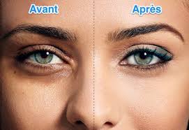 A Cause De La Fatigue Du Stress D Une Mauvaise Hygiene De Vie Des Cernes Peuvent Apparaitre Sous L Dark Eye Circles Dark Circles Under Eyes Undereye Circles