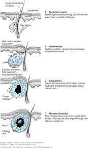 Chapter 3 The Acute Inflammatory Response Concise