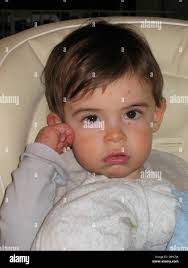 Epidermolysis hi-res stock photography and images