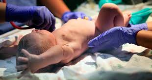 Image result for Neonatal Circumcision