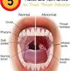 In the early stage of mouth cancer, it looks exactly like an ulcer. 1
