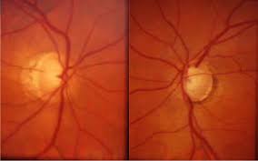 Jun 26, 2019 · glaucoma is a group of eye diseases that can cause vision loss and blindness by damaging the nerve in the back of your eye called the optic nerve. Optic Nerve Photographs Of Subject 2 Demonstrate Glaucomatous Optic Download Scientific Diagram