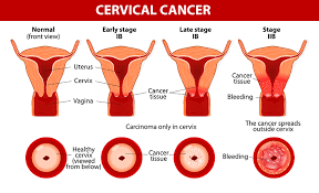Once the cancer has advanced to the later stages, the irregular cells can spread and cause serious issues like bone fractures or urine and feces. Cervical Cancer Treatment And Surgery Bangalore India Oncoindia