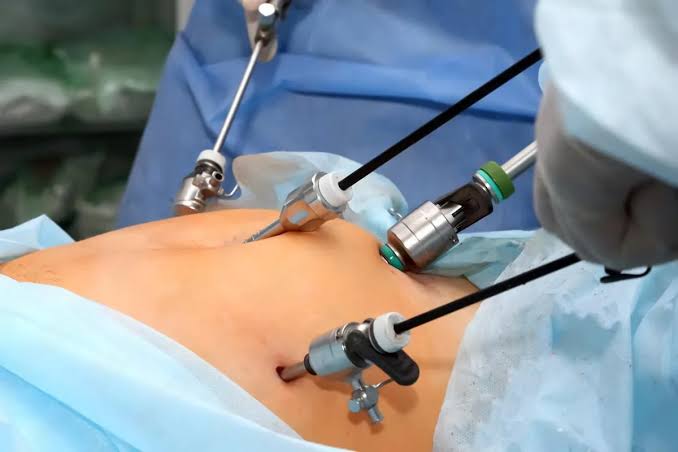Colecistectomia videolaparoscópica: o que é e indicação
