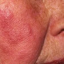 Image result for red rash face