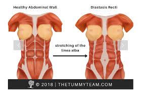 Check spelling or type a new query. Diastasis Recti What You Need To Know Active Moms Club